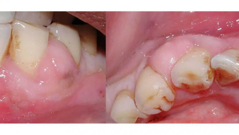 How Long Can A Tooth Abscess Be Left Untreated?
