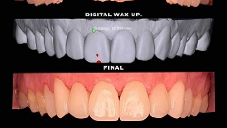 How Can Dental Implants Change the Ways of Your Life?