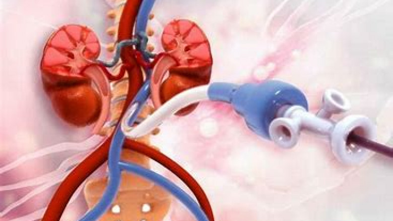 Peripheral Artery Revascularisation Market 2022 | Top Key Players Analysis Report Till 2028