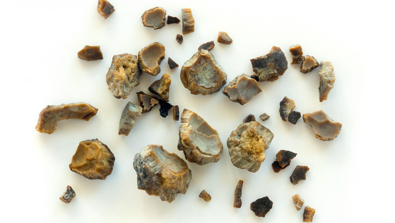 A Comprehensive Guide On Cystine Stones