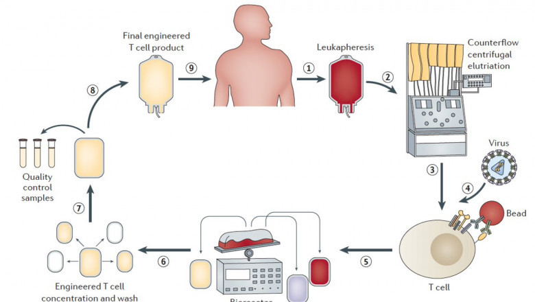 A Leukapheresis Is Used To Treat Chronic Lymphocytic Leukemia (CLL) Or Hyperplastic Blood Cells