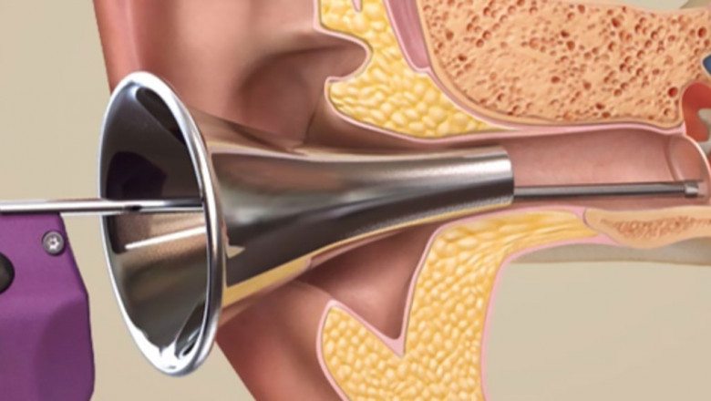 The Global Tympanostomy products Market is expected to grow due to an Increase in Ear Infections