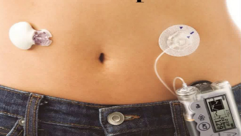 An Tubeless Insulin Pump Is a Device That Administers Insulin Directly Into the Body Through a Tiny Tube Implanted Beneath the Skin