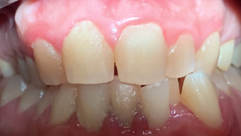 What Happens If You Don't Get An Implant After Tooth Extraction?