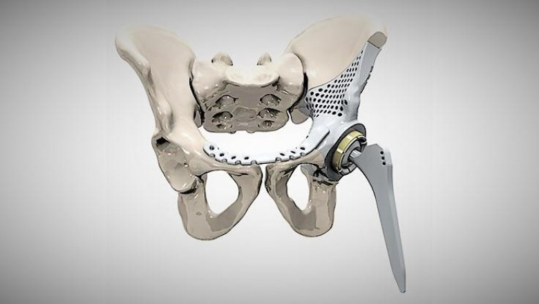 The 3D Printed Medical Implants  Used For Surgical Equipment Designed Specifically For The Anatomy Of A Patient