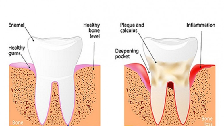 Tooth Extraction Near Me