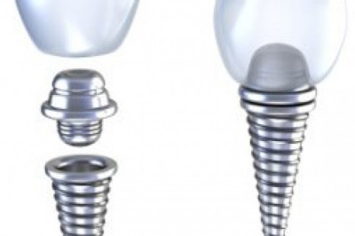 tooth replacement Houston