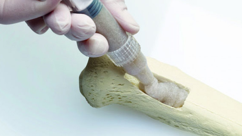Demand Market for Bone Grafts and Substitutes to Expand More Than 1.4X by 2028