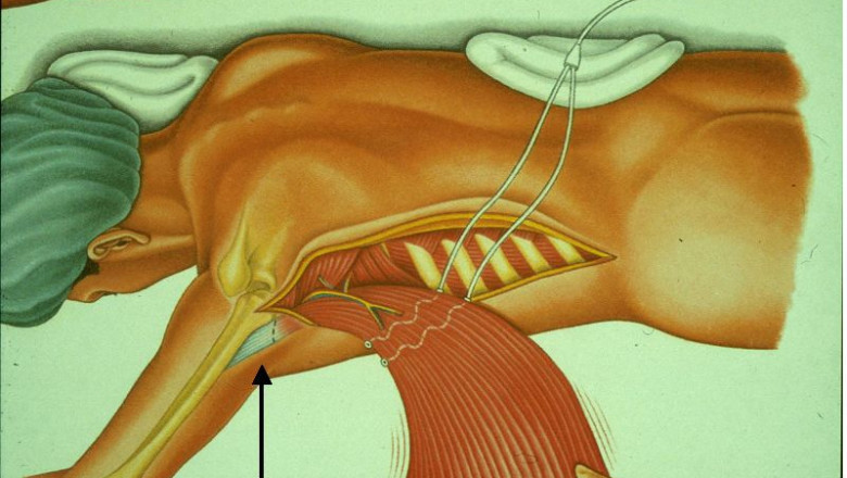 CARDIOMYOPLASTY : What is it, Types, Experience, and Risks | Heart Hospital in Lucknow