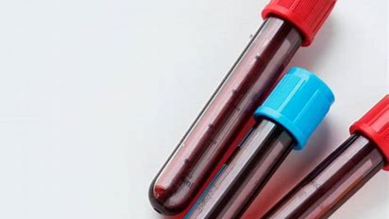 C-Reactive Protein Test Market Analysis, Size, Share, Growth and Trends Report To 2028