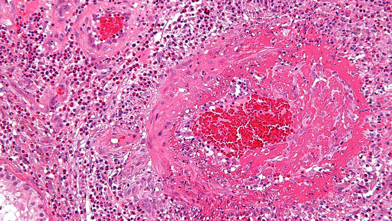 Inflammation of the blood vessels characterized by microscopic polyangiitis