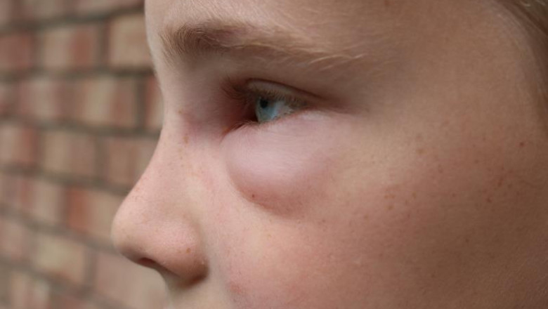 A global outlook on the hereditary angioedema market, share, size, growth, opportunity, and forecast 2022-2030