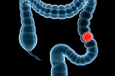 Corona Virus Outbreak : DNA Bowel Cancer Screening Kits Market Research Report Forecast and Opportunities Till 2028