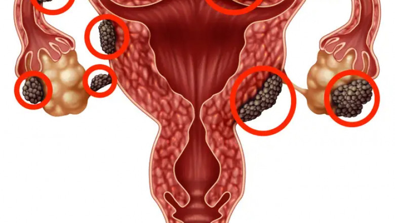 Endometriosis Market  Share, Price, Trends Analysis By 2029