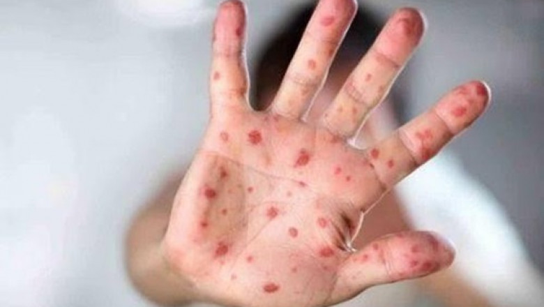 What is Tomato Flu? Early Symptoms & Preventive