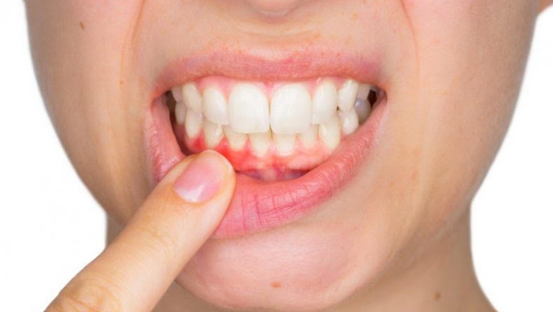 How Long Does A Tooth Infection Go Untreated?