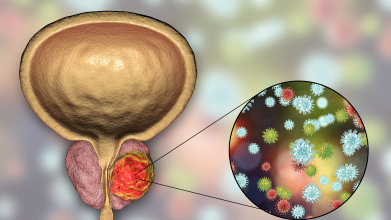 Report on Prostate Cancer Therapeutics Market Research 2028 - Value Market Research