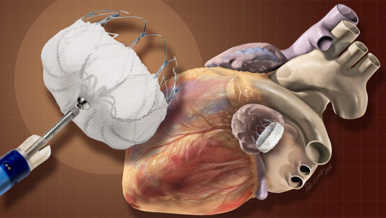 The transcatheter occlusion and embolism devices market: Global industry trends, share, size, growth, opportunity and forecast 2022-2028