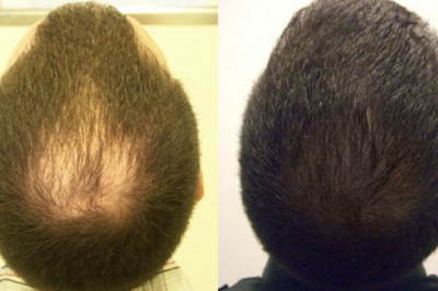 The Crown Hair Transplant Timeline