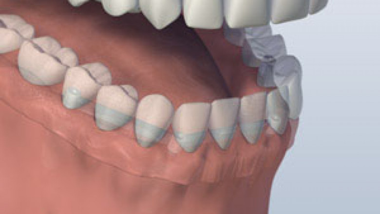 Before beginning the process of full mouth restoration, go to the dentist first.