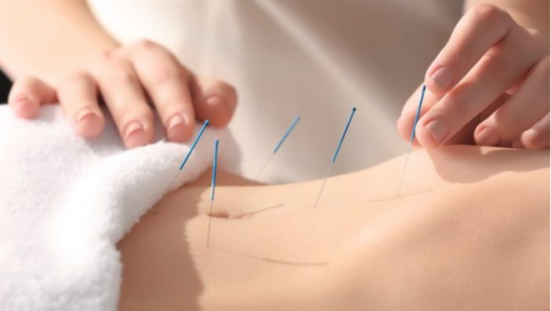 Traditional Acupuncture and Traditional Chinese Medicine Perth