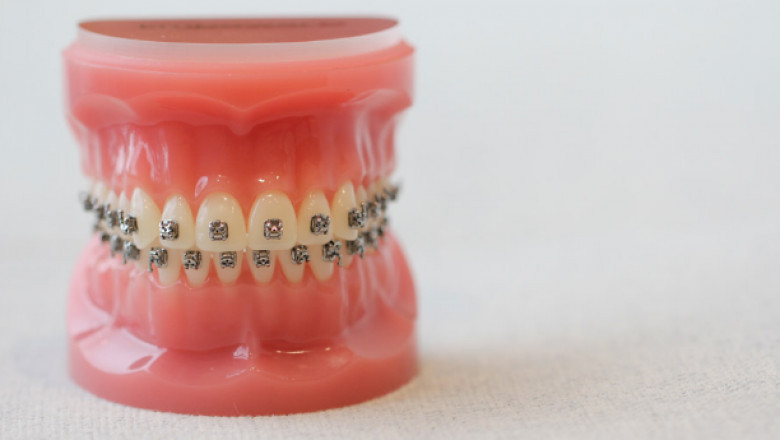 Maintaining Proper Oral Hygiene with Aligners Can Be Difficult