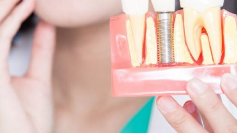 Why Dental Implants Prove To Be The Best Replacement Option For Missing Tooth?