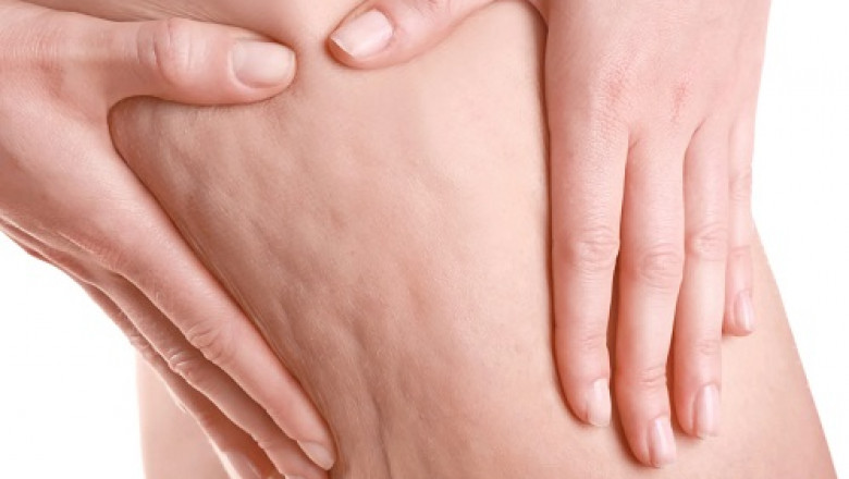 A global analysis of the Cellulite Treatment Market, including its share, size, growth, and opportunities
