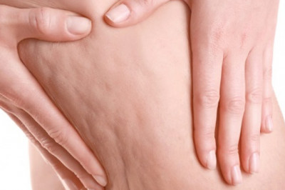 A global analysis of the Cellulite Treatment Market, including its share, size, growth, and opportunities