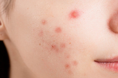 Best Acne Treatment in Utah - Revere Health