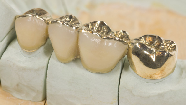 Dental Inlays and Onlays Market 2022 Size, Growth Factors &amp; Forecast Report to 2028