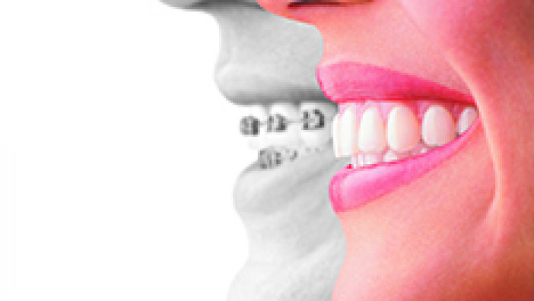 Smile Confidently Again With Invisalign Dentistry