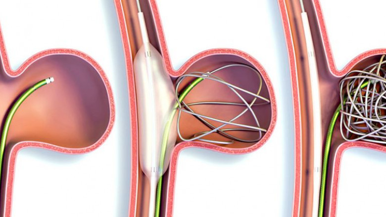 All You Need To Know About Atherectomy Devices And Its Types