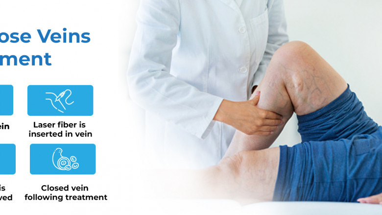 Best Varicose Veins Treatment in Hyderabad