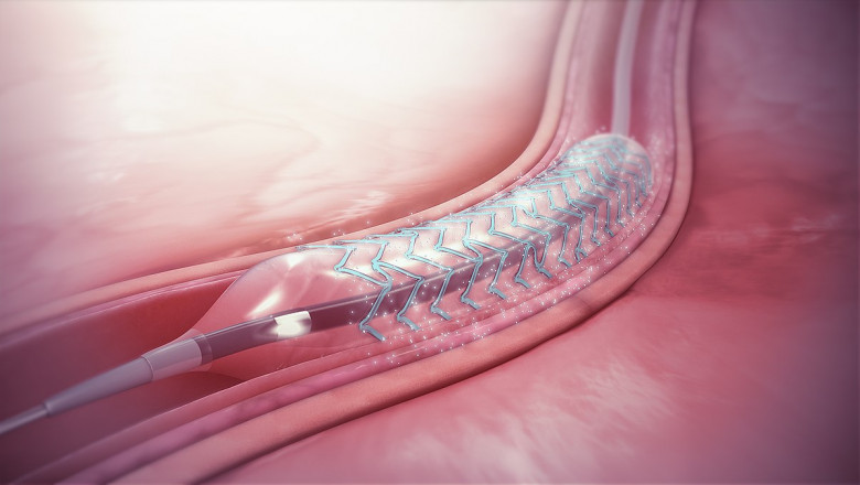 Biodegradable Stents Market, including Global Trends, Share, Size, Growth, Opportunity, and Forecast to 2026
