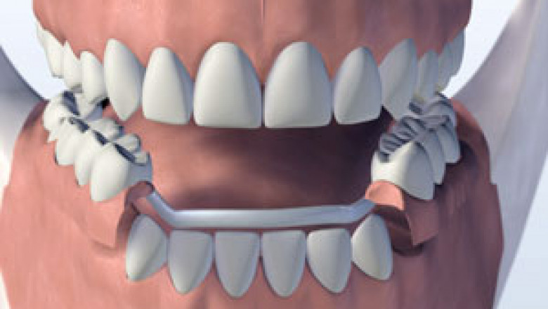 What Makes Dental Implants the Best Option for Replacing Missing Teeth?