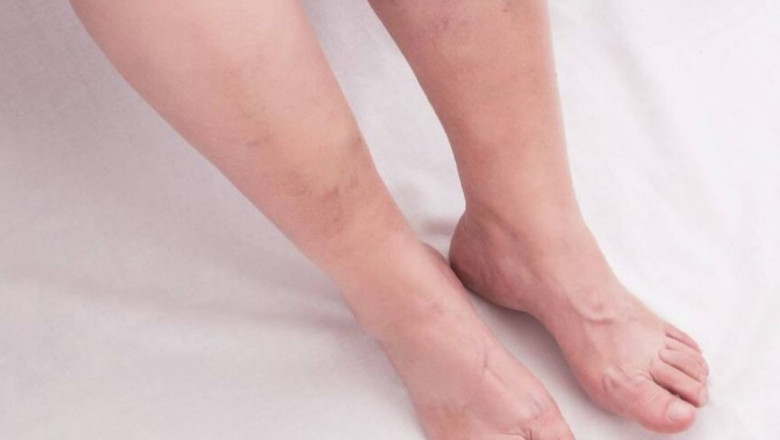 Chronic Venous Insufficiency