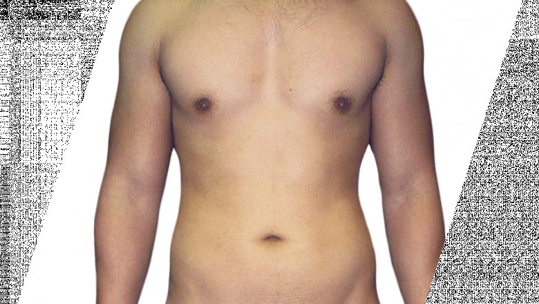 Why Is It Essential To Drink So Much Water After Liposuction Surgery?