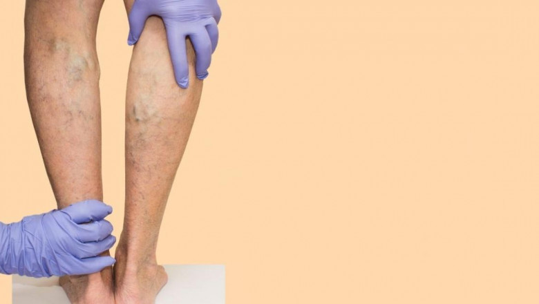 Spider Veins