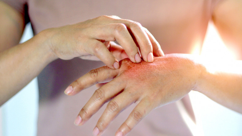 Global Psoriasis Treatment Market Overview