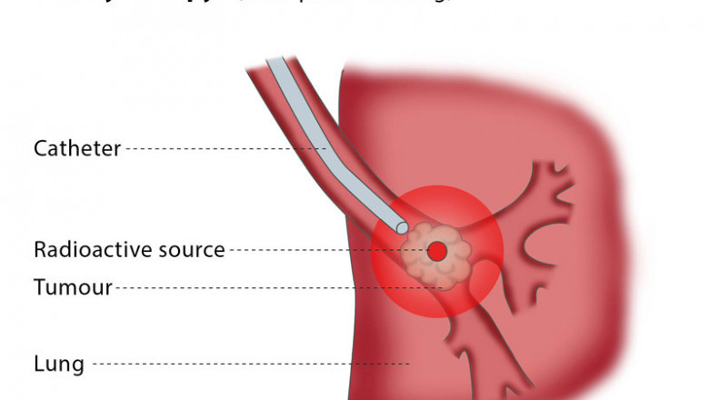 The Brachytherapy Treatment Is A Type Of Radiotherapy Used In Cancer Treatment