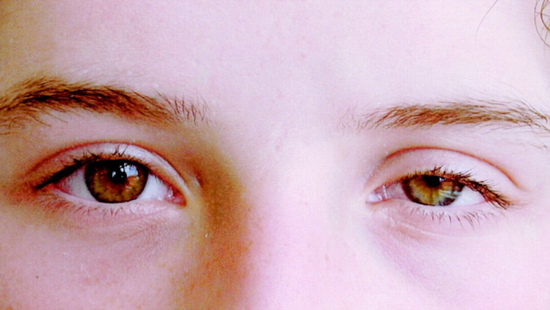 What Exactly is Behcet's Syndrome