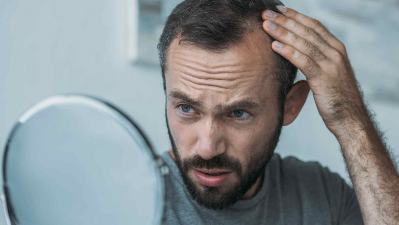 Get the Best Hair Transplant in Mumbai With Dr. Sumit Agarwal