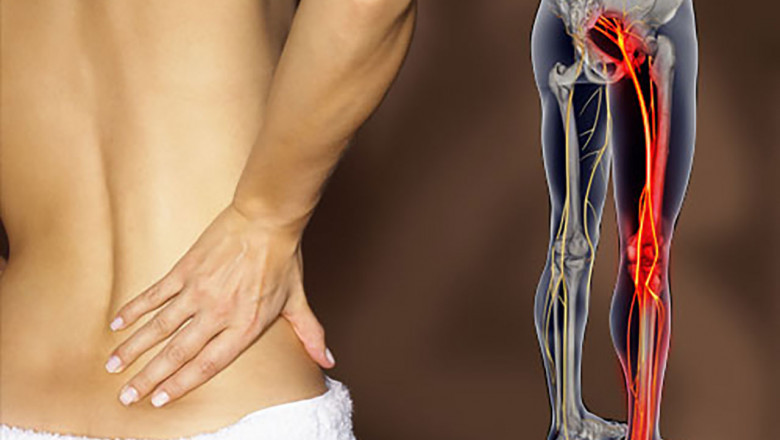Sciatica Pain Can Occur At Any Point Along the Nerve Pathway