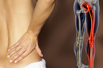 Sciatica Pain Can Occur At Any Point Along the Nerve Pathway