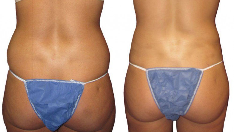 How to Choose The Best Surgeon For BBL Surgery?