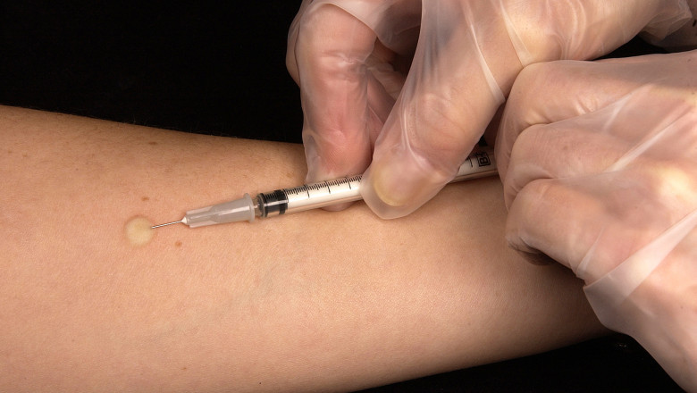 Tuberculin Skin Test Market size is expected to grow to USD 3,380.7 million by 2030