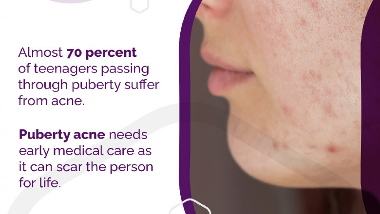 5 Reasons to See a Dermatologist for Acne Treatment
