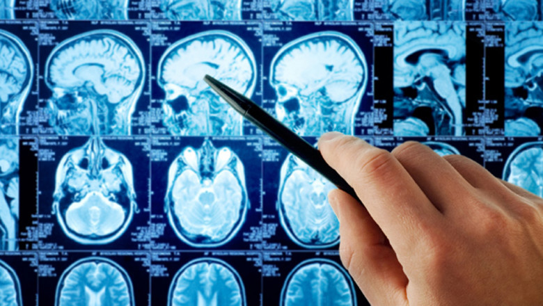 Adult Malignant Glioma Therapeutics Market Size, Share, Trends &amp; Forecast 2029