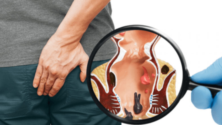 Get The Right Treatments For Piles In Navi Mumbai!